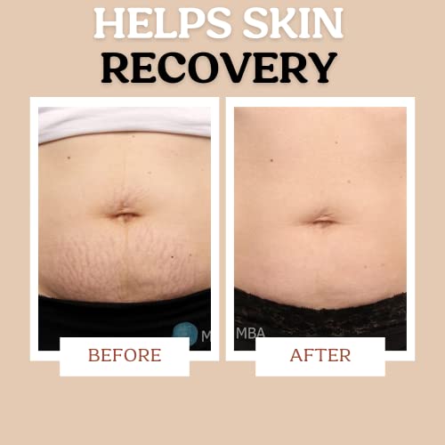 Pregnancy Stretch Mark Cream | Plant-Based Elasticity & Prevention