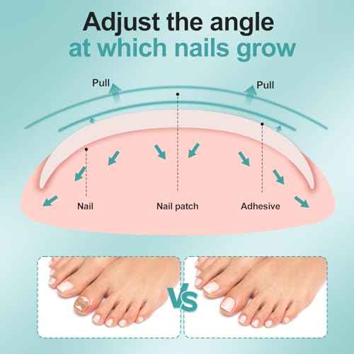 Ingrown Toenail Corrector Set with Correction Strips, Professional Ingrown Toenails Pedicure Tool Set, Painless File and Lifter Pedicure Tools Pedicure Tools,Ingrown Nail Tool for Women Man(1 Count)