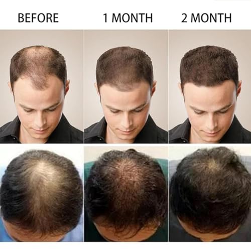 5% Minoxidil Hair Growth Cream for Men & Women - Anti Hair Loss Treatment with Biotin