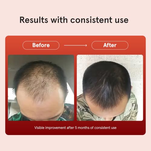 Keeps Minoxidil Foam 5% for Men - 3-Month Hair Regrowth Treatment, Thicker Fuller Hair Support