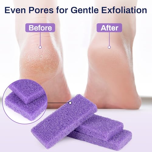 20 Pack Small Pumice Stones for Feet - Exfoliating Foot Callus Remover
