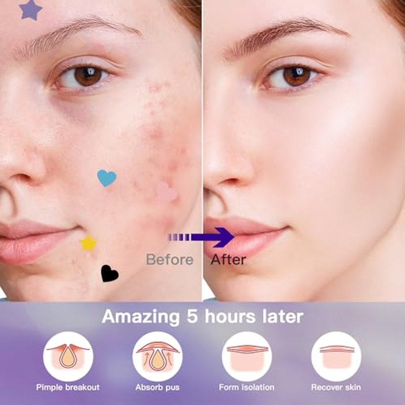 312CT Star Pimple Patches for Face Hydrocolloid Mighty Patch Star&Invisible Acne Patches,5Sizes 6Colors Cute Stickers Acne Pads Parches Acne For Body,Chin,Forehead,Full Face Zit Patch Acne Dots