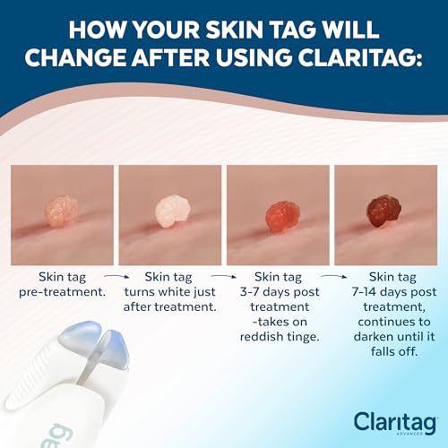 Claritag Advanced Skin Tag Remover - FDA-Cleared Cryogenic Kit