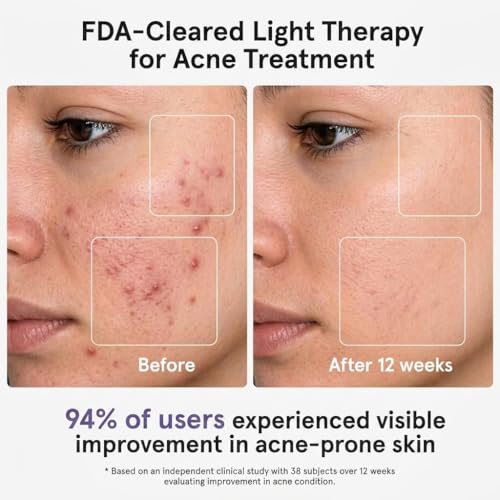 MICEYLIVE Red Light Therapy Face Mask with LED & NIR – 432 LEDs for Clearer Skin