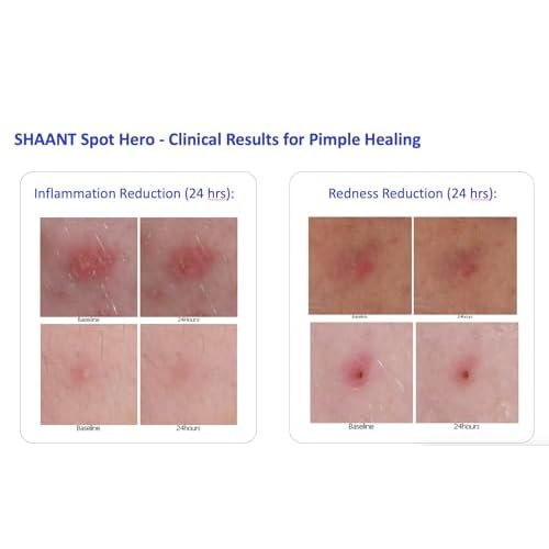 Codex Labs Shaant Spot Hero ? Clinically Tested 5% Sulfur Acne Spot Treatment | Shrinks Breakouts Without Over-Drying | For Sensitive, Blemish-Prone Skin | 0.5 oz