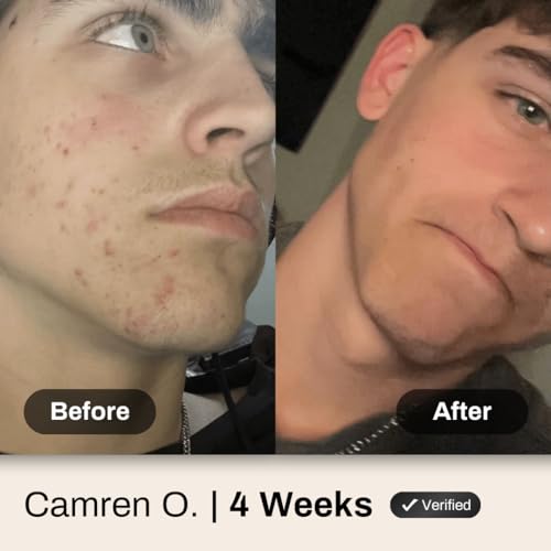 Shield Men's Acne System - Face Wash, Moisturizer & Patches