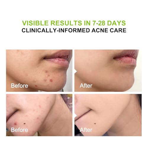 2% Salicylic Acid (BHA) Serum for Acne & Blackheads - Unclogs Pores, Oil Control, Sensitive-Skin Safe, Fragrance-Free,1 fl.oz