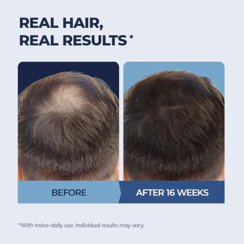 5% Minoxidil Hair Growth Serum for Men & Women, 2-Pack