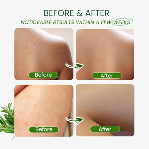 Tea Tree Antifungal Body Wash – Jock Itch, Athlete's Foot & Skin Relief