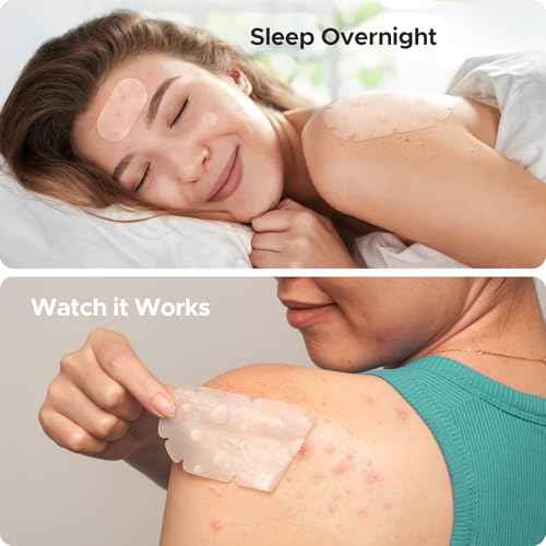 XXL Pimple Patches for Body, Large Hydrocolloid Acne Patches, 5 Sizes Big Hydrocolloid Bandages for Back, Chest, Shoulders Zit Breakouts, Blemish Patch for Face (Oval, Dot 260 Count)