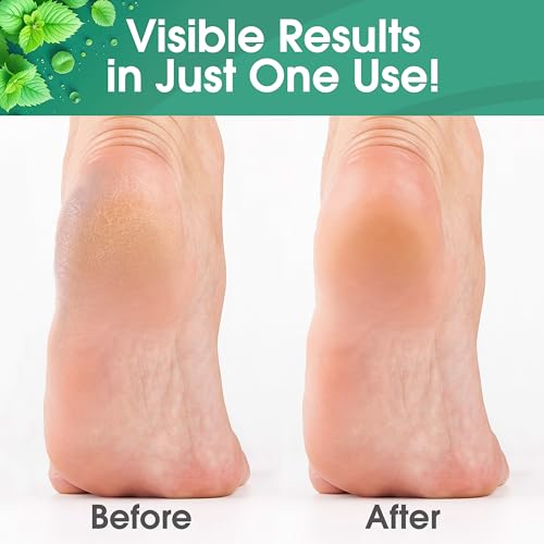 Extra-Strength Callus Remover Gel for Feet - 8oz Cool Mint