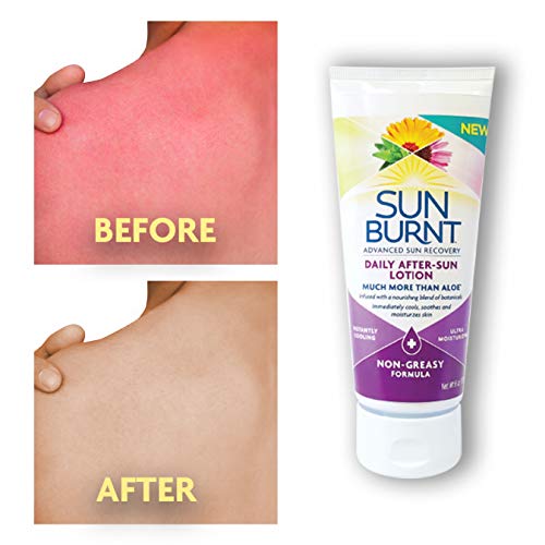 SunBurnt After-Sun Lotion, 6 oz - Cooling & Hydrating Relief