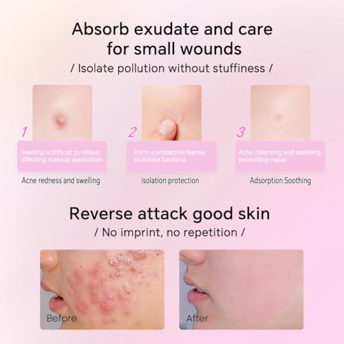 Loske Pimple Patches - 388 Count, 6 Sizes, Hydrocolloid Acne