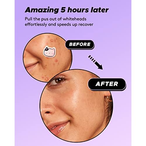 LitBear Acne Patch Pimple Patch, Cat Shaped Acne Absorbing Cover Patch, Hydrocolloid Acne Patches For Face Zit Patch Acne Dots, Tea Tree Oil & Salicylic Acid, 96 Patches, 12mm