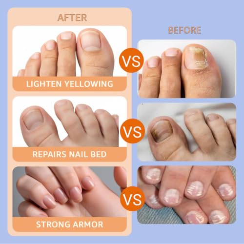 MKIAL 21 Pack Nail Care Patches for Damaged Nails, 8-Hour Overnight Repair & Strengthening