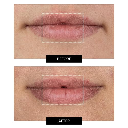CurrentBody LED Lip Perfector - Anti-Aging Wearable Device