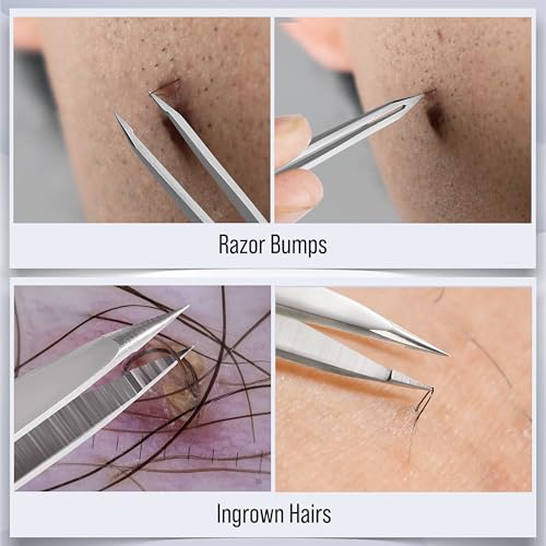 DUROX 3-Piece Tweezer Set ? 1.Pointed Ingrown Hair Tweezers, 2.Fine-Tip Splinter Tweezers, 3.Safety Round Tip for Facial & Chin Hair Removal. Made of stainless steel. Protective pouch for safe storage