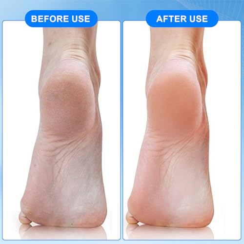 4-in-1 Foot Scrubber Brush Set - Pumice Stone & Callus Remover