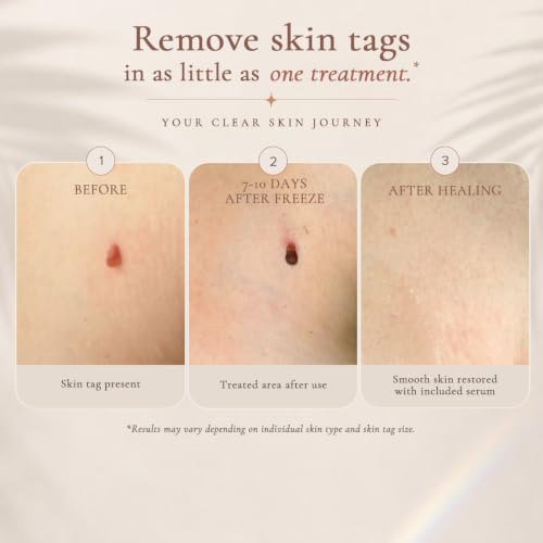 Skin Clinic Freeze 'n Clear Cryogenic Skin Tag Removal Kit with Post-Treatment Serum