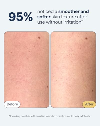 Remedy KP Exfoliating Body Scrub for Keratosis Pilaris 6.8oz