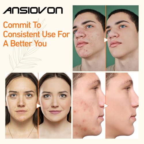 Blue Light Therapy Device for Acne Spot Treatment - LED Acne Blue Light Therapy Wand for Face