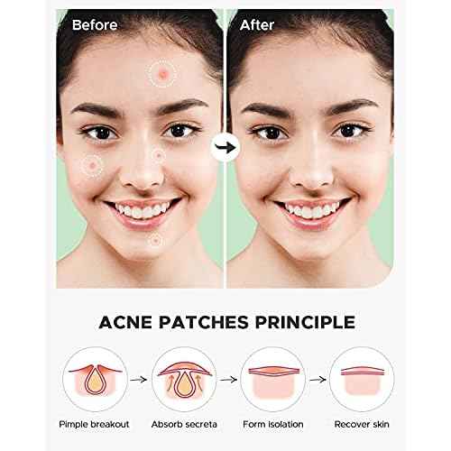 Pimple Patch (360 Counts 4 Sizes), Hydrocolliod Acne Patch for Face, Invisible Zit Patch with Tea Tree Oil & Calendula Oil, Blemish Patch