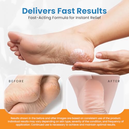 40% Urea Advanced Foot Cream Kit with Pumice Stone & Brush - 4 oz
