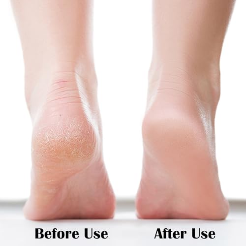 Nano Glass Foot File Callus Remover for Dead Skin & Cracked Heels