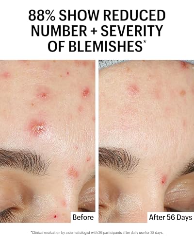 Allies of Skin Azelaic & Kojic Face Serum for Clear Skin - 1 Fl oz
