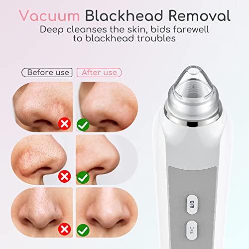 HD Camera Blackhead Remover Vacuum with LED Lighting - 3 Modes, 6 Suction Heads, Smartphone App