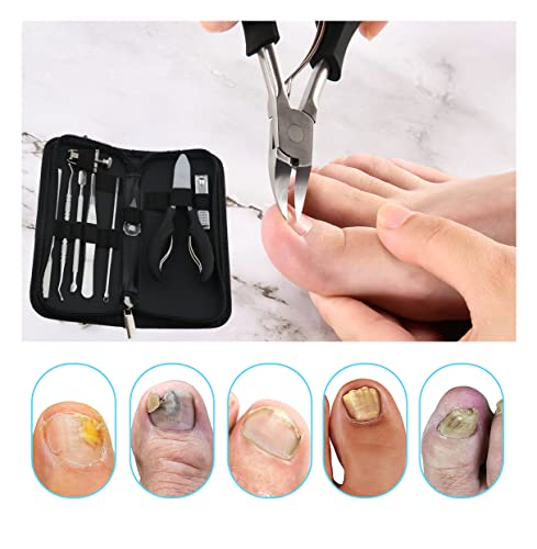 Ingrown Toenail Tools Kit - 10 Pcs Professional Pedicure Set