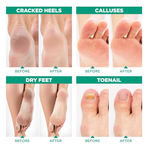 Lavinso Tea Tree Oil Foot Soak with Epsom Salt for Sore Feet & Calluses - 1 lb