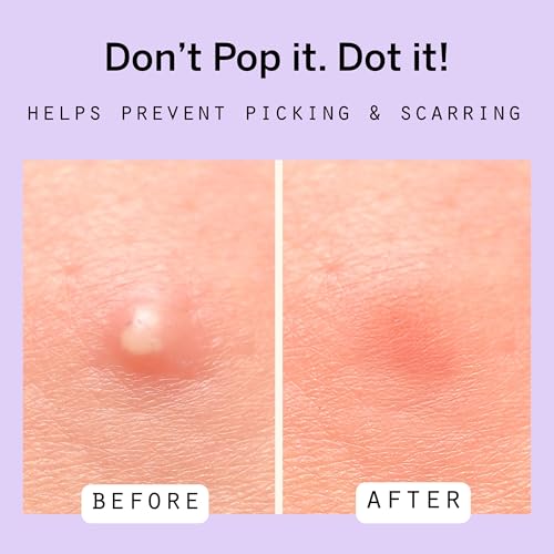 Pixie Cup Dot Hydrocolloid Blemish Patches for Face ? Invisible Skin-Covering Stickers with Tea Tree Oil & Vitamin C ? Ultra-Thin Cosmetic Patches for Visible Blemishes (8, 10, & 12 mm, 76 ct)