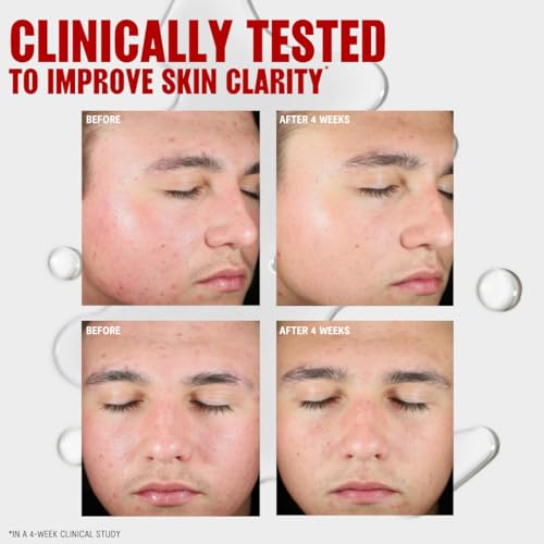 Thayers 2% Salicylic Acid Blemish Clearing Acne Treatment Face Toner - 12 fl oz
