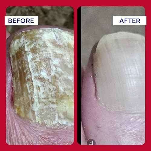 EMUAIDMAX Homeopathic Psoriasis Scalp Treatment Serum ? Natural First Aid Concentrate for Dry, Itchy Scalp Relief and Skin Irritations from Psoriasis, Eczema, and Dermatitis, 1oz