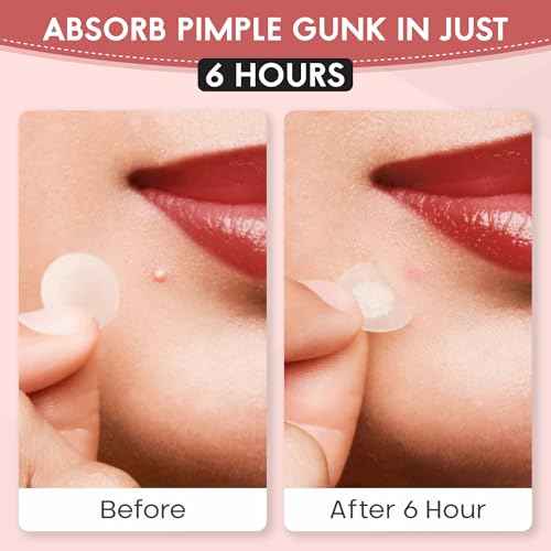 Zovira Original Spot Patches - Advanced Blemish Patches with Niacinamide, Tea Tree & Neem Oil (36ct) for Day & Night Use