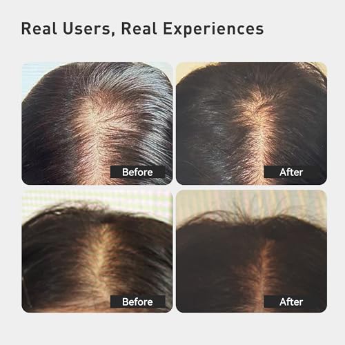 KINTOR KX-826 Hair Growth Foam for Women - 60ml DHT Blocker