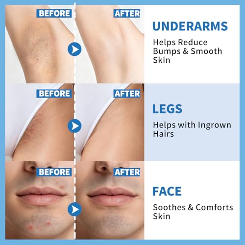 dewyhour Ingrown Hair & After Shave Soothing Serum?Soothes Razor Irritation, Targets Dark Spots,Helps With Razor Bumps for Face,Underarms,Neck & Bikini Area,Korean Skincare Roll-On for Men & Women