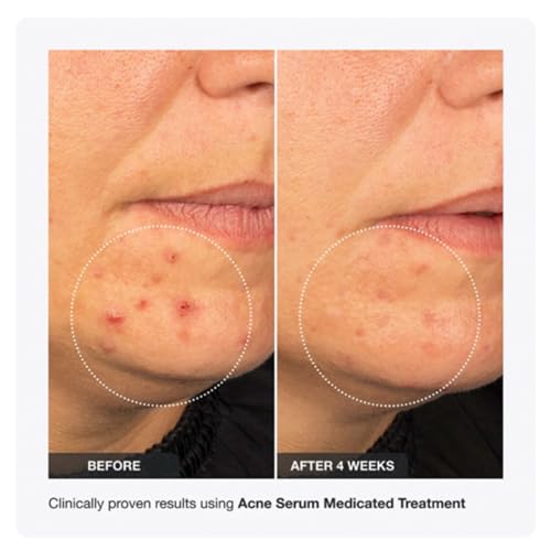 INNBEAUTY Project Acne Serum Medicated Treatment for Breakouts, Blackheads & Oil Control, 1 OZ (30ml)