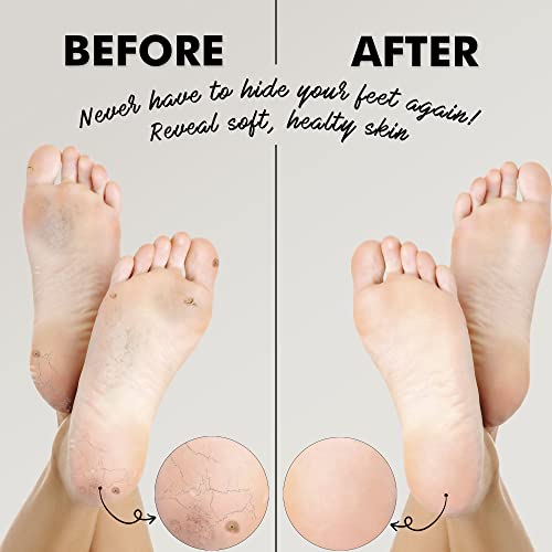 Natural Lava Pumice Stone for Feet - Callus Remover, Pack of 2