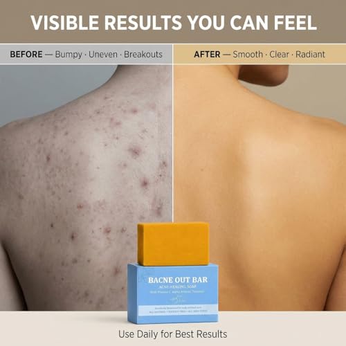 Turmeric Acne Soap Bar – Back, Face & Chest Cleanser