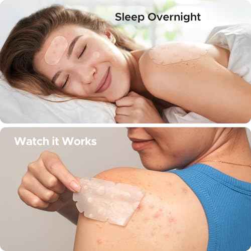 XXL Pimple Patches for Body, Large Hydrocolloid Acne Patches, 5 Sizes Big Hydrocolloid Bandages for Back, Chest, Shoulders Zit Breakouts, Blemish Stickers for Face (Oval, Dot 110 Count)