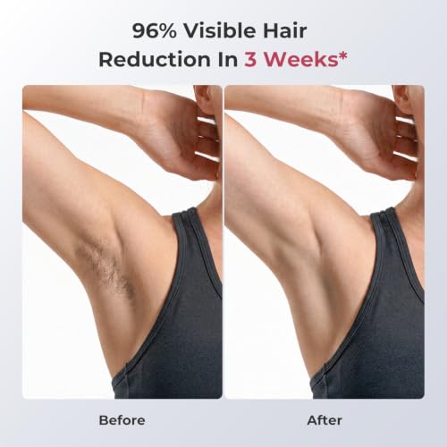 Ubroo IPL Laser Hair Removal Device Rose - 21J Energy, Painless at-Home Hair Reduction