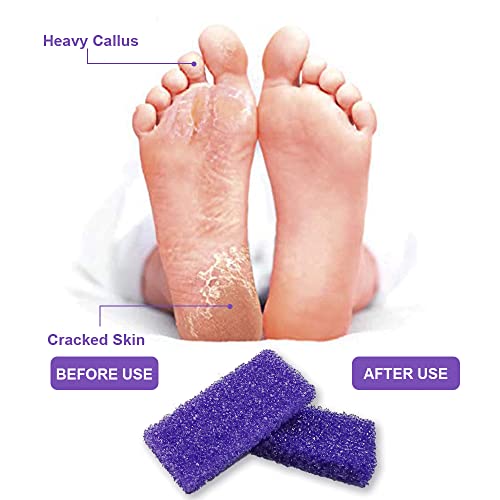 40 PCS Foot Pumice Stone Set - Professional Callus Remover for Smooth Feet