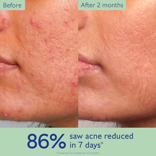 Caudalie Vinopure Acne Treatment, Salicylic Acid Serum to Treat and Prevent Blemishes - 30 mL