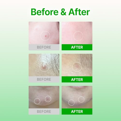ACROPASS Trouble Care Microcone Acne Patch, Spot Care for Early Pimple and Zits, Hydrocolloid & Niacinamide for Blemishes (Regular Size 24count)