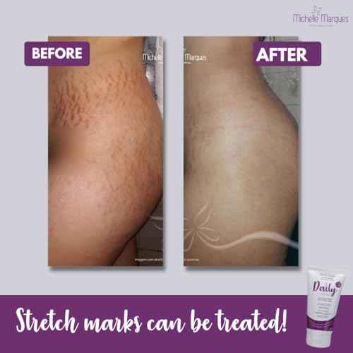 Stretch Mark Cream, Soften and Reduce the Appearance, Provides Hydration, and Improves Skin Elasticity and Texture, 5.29oz