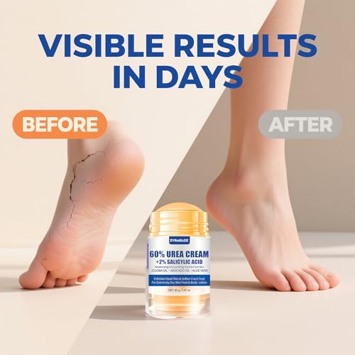 ZyraGloz 60% Urea Cream Stick with 2% Salicylic Acid for Cracked Heels