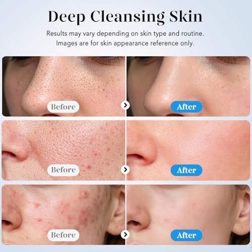 GUGUG Skin Scrubber Face Spatula Skin Spatula Pore Cleaner Blackhead Remover Tools for Facial Deep Cleansing-4 Modes -White