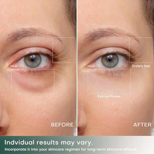 ALUSHEE 2-in-1 RF Microcurrent Eye Device for Puffiness & Wrinkles